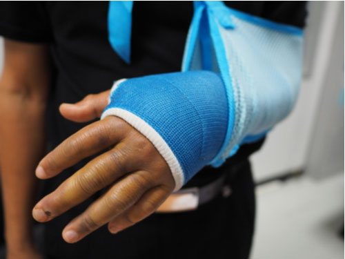 man with a broken arm who needs a Douglasville personal injury lawyer