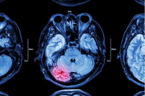 MRI that Union City traumatic brain injury lawyer will use as evidence